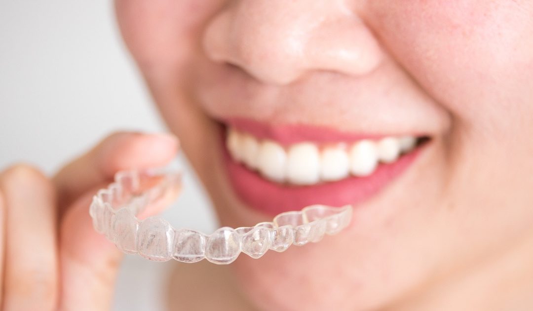 Apparecchi per i denti: scegli il design e la funzionalità di Invisalign