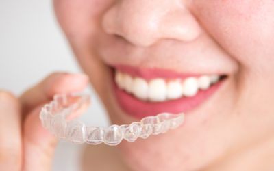 Apparecchi per i denti: scegli il design e la funzionalità di Invisalign