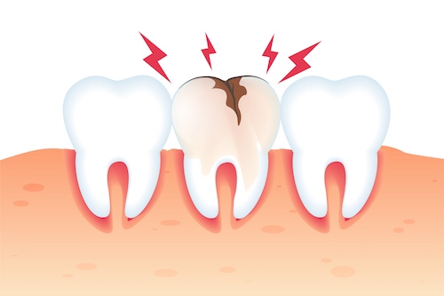 illustrazione che descrive carie dentale