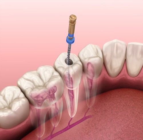 devitalizzazione-di-un-dente-procedura