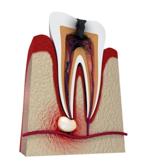 Illustrazione di un dente in necrosi