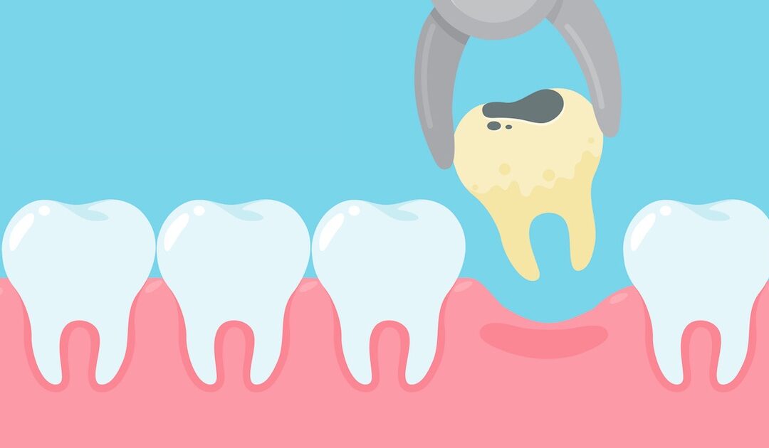 Estrazione Dentaria: tutto quello che devi sapere