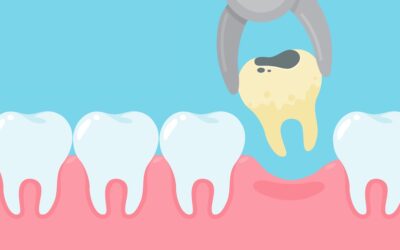 Estrazione Dentaria: tutto quello che devi sapere