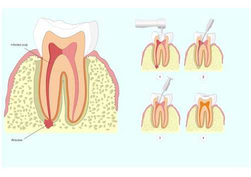 Ascesso e Infezione al Dente