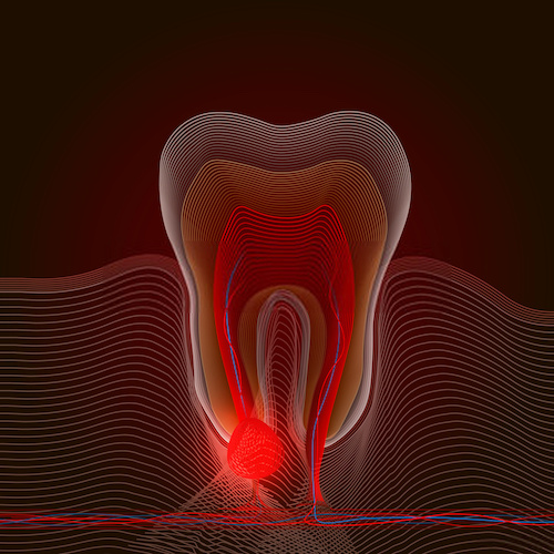 Infezione al Dente